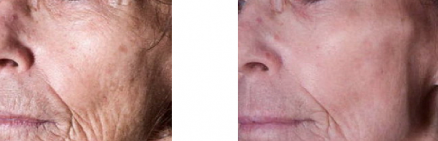 peeling phénolé joue