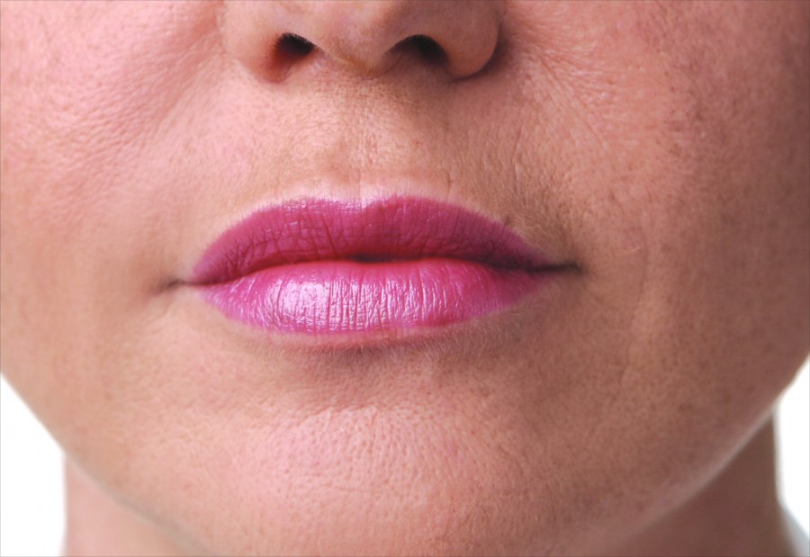 volume_lips_apres
