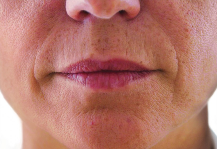 volume_lips_avant